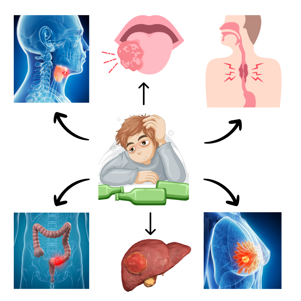 Specific Cancers Linked to Alcohol